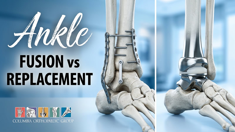 Webinar - Ankle Arthritis: Modern Treatment Options to Keep You Moving.