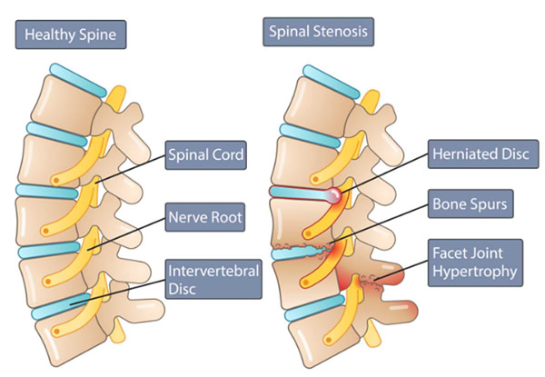 Lumbar Spinal Stenosis | Columbia Orthopaedic Group
